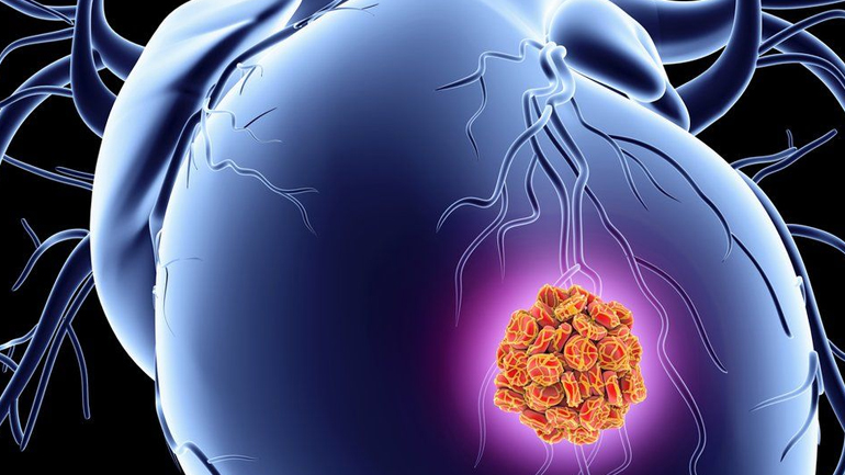 «Τσιρότο» μειώνει τη ζημιά στην καρδιά ύστερα από έμφραγμα